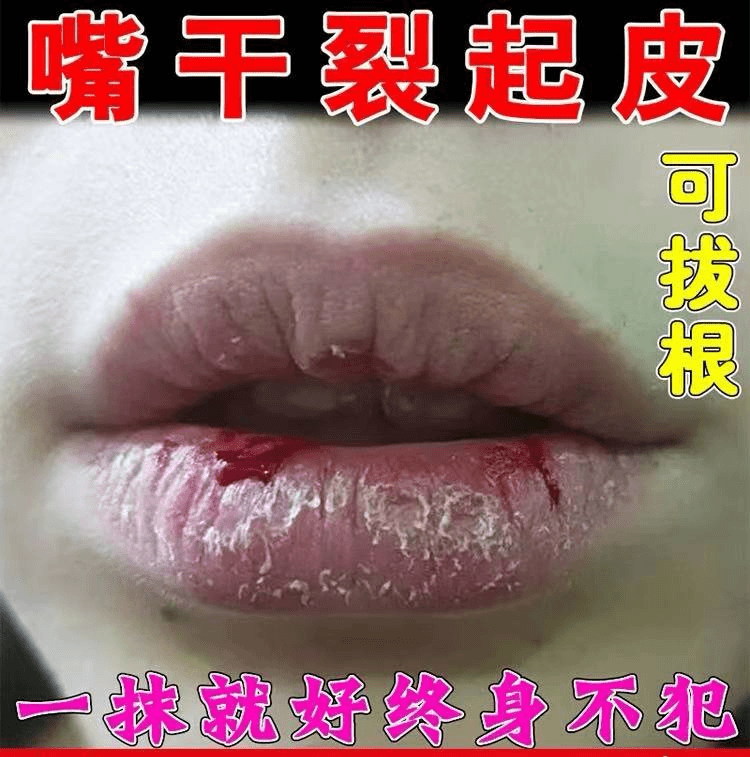 秋冬嘴巴干裂脱皮修护嘴唇干裂脱皮张嘴就疼嘴角开裂口角干裂软膏