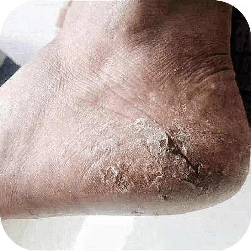 脚后跟干裂修复霜皲裂手足龟裂足裂开裂皴裂治手脚底裂口脱皮起皮